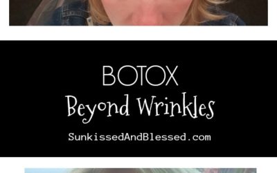 Botox-My Why and My Results